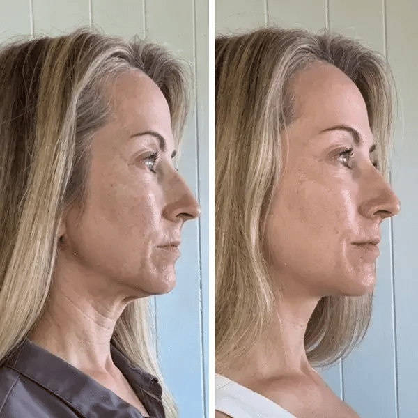 TAFFL Artisan: The 7-Layer Penetration System™ – LED and EMS Skin Rejuvenator + FREE Gift